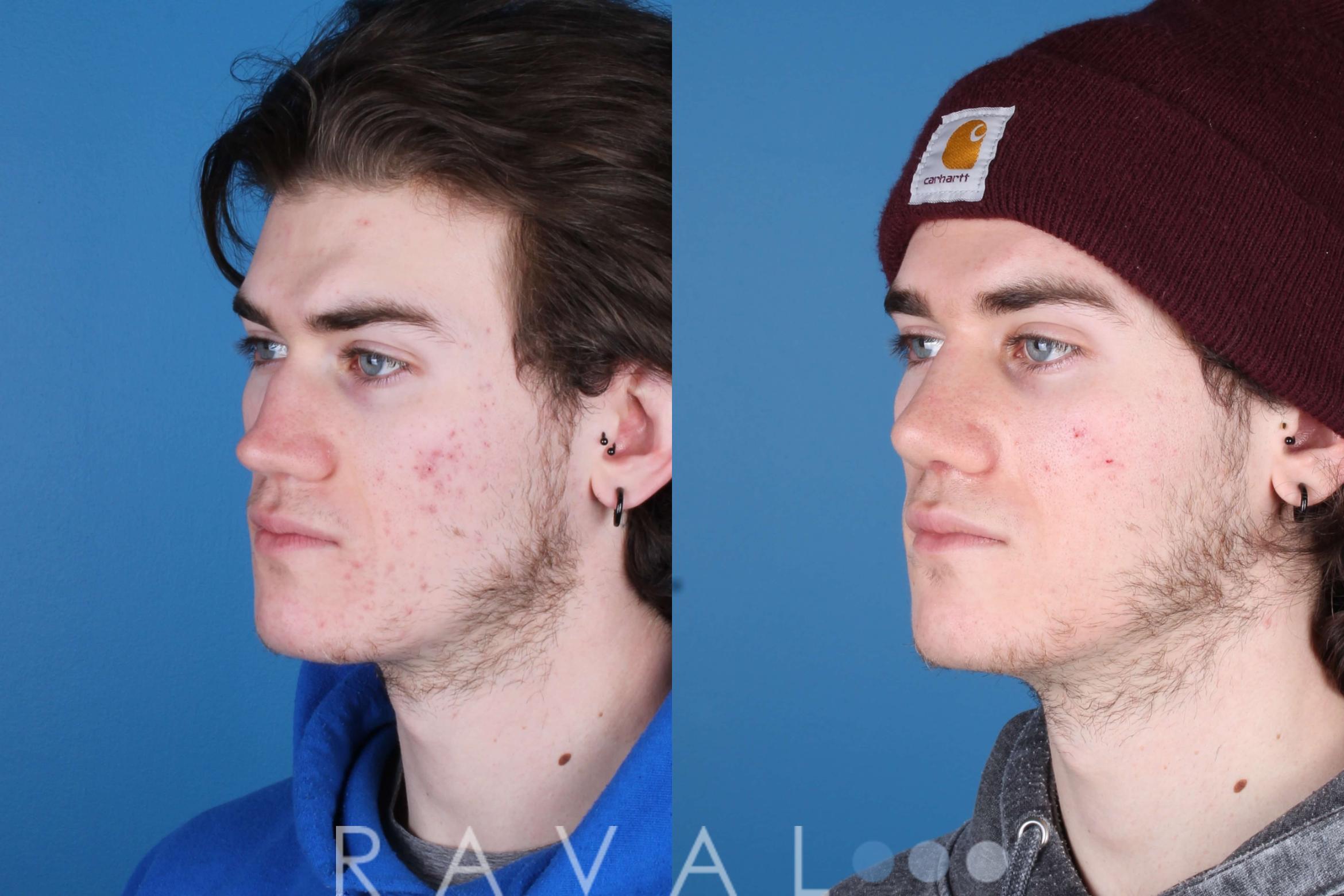 Before & After Rhinoplasty Case 1035 View 4 View in Denver, CO