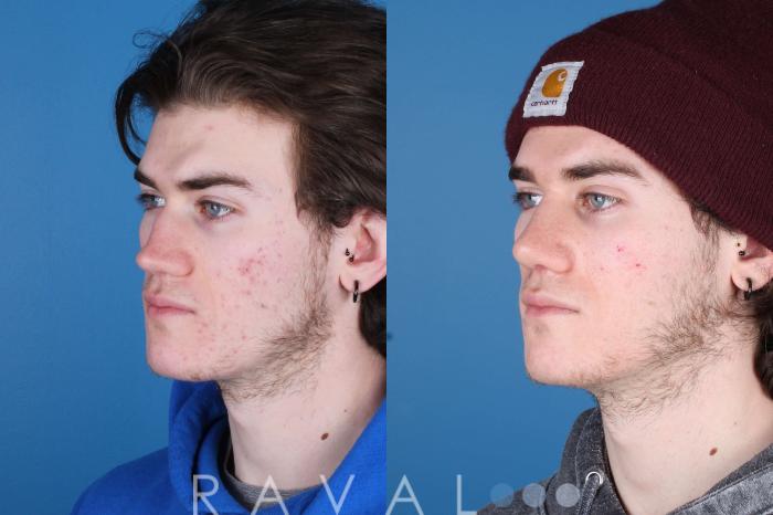 Before & After Rhinoplasty Case 1035 View 4 View in Denver, CO