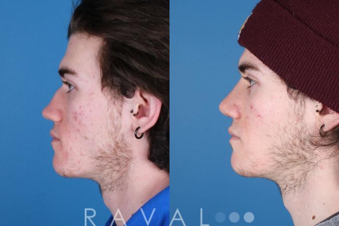 Before & After Rhinoplasty Case 1035 View 5 View in Denver, CO
