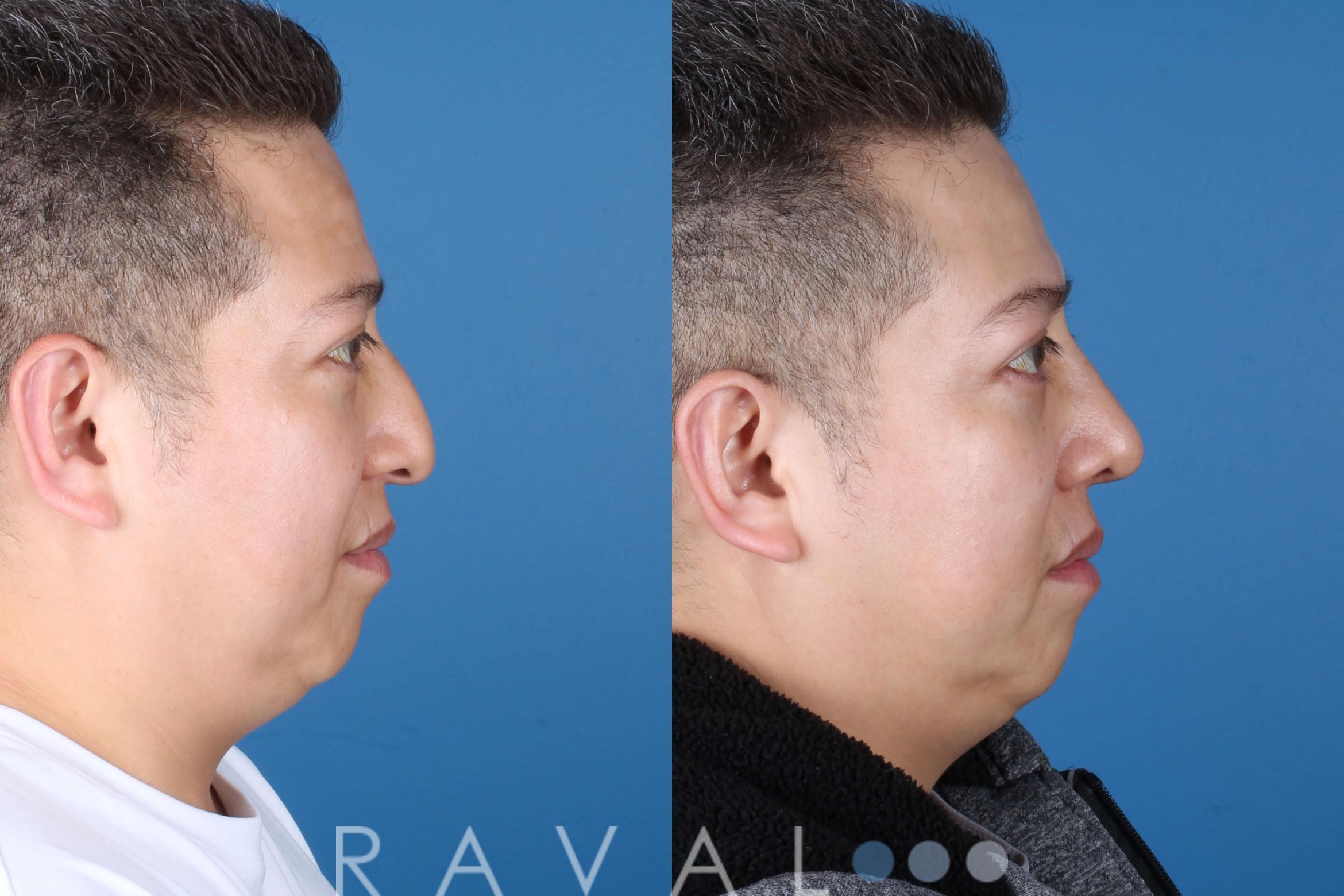 Before & After Rhinoplasty Case 1036 View 1 View in Denver, CO