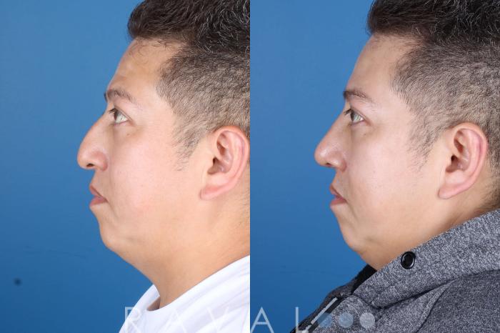 Before & After Rhinoplasty Case 1036 View 2 View in Denver, CO