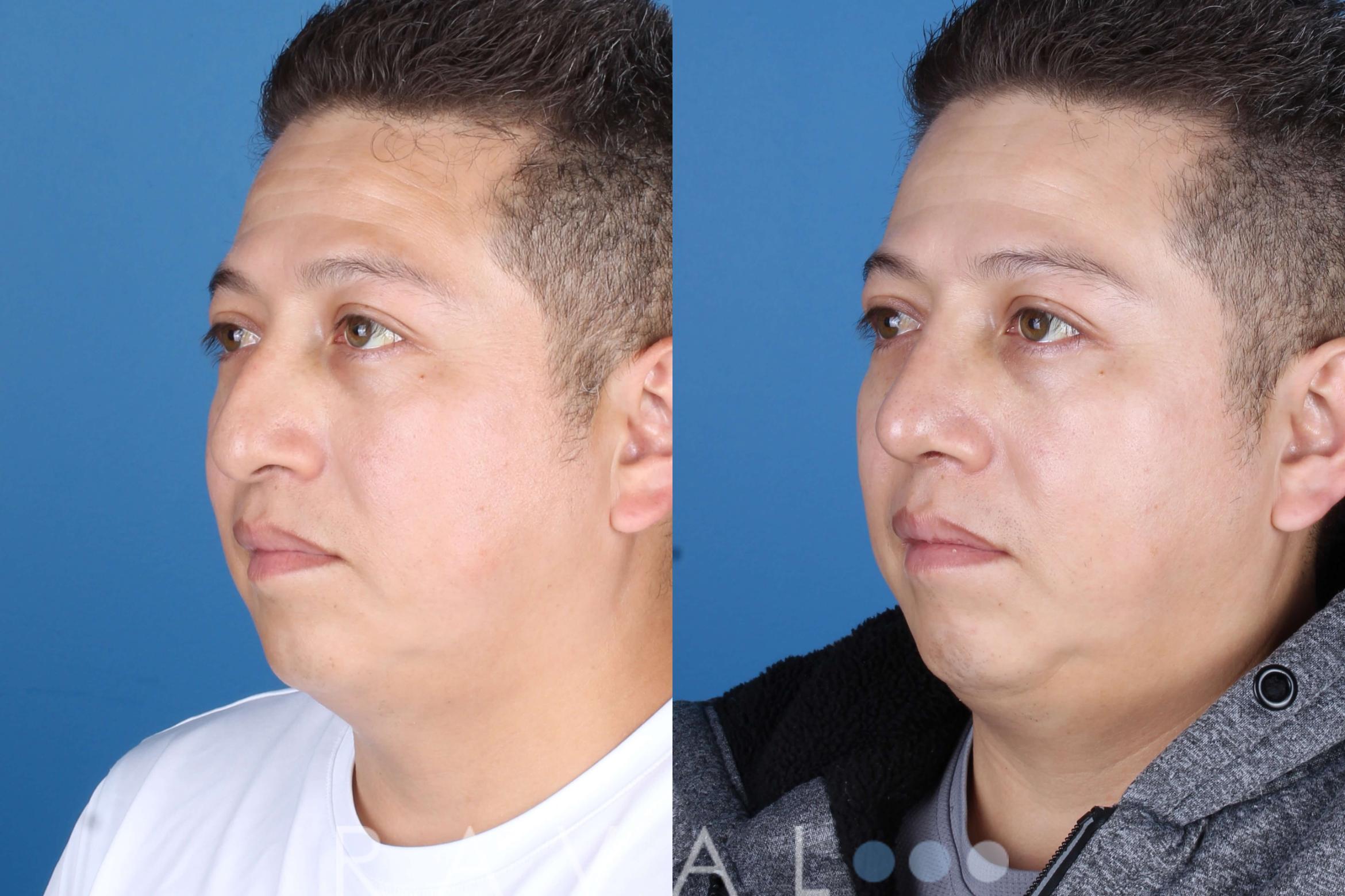 Before & After Rhinoplasty Case 1036 View 3 View in Denver, CO