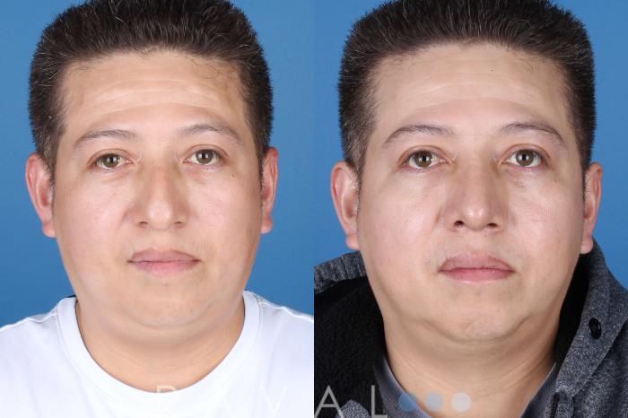 Before & After Rhinoplasty Case 1036 View 4 View in Denver, CO