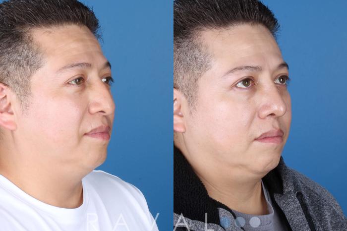 Before & After Rhinoplasty Case 1036 View 5 View in Denver, CO