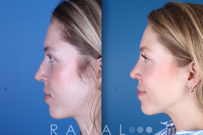 Before & After Rhinoplasty Case 1037 View 1 View in Denver, CO