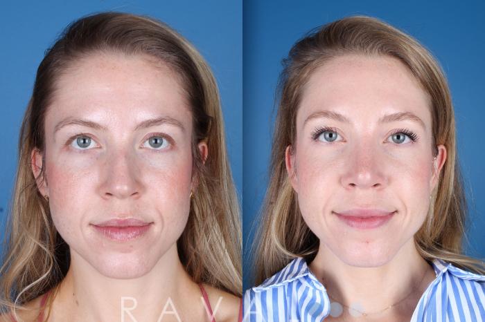 Before & After Rhinoplasty Case 1037 View 2 View in Denver, CO