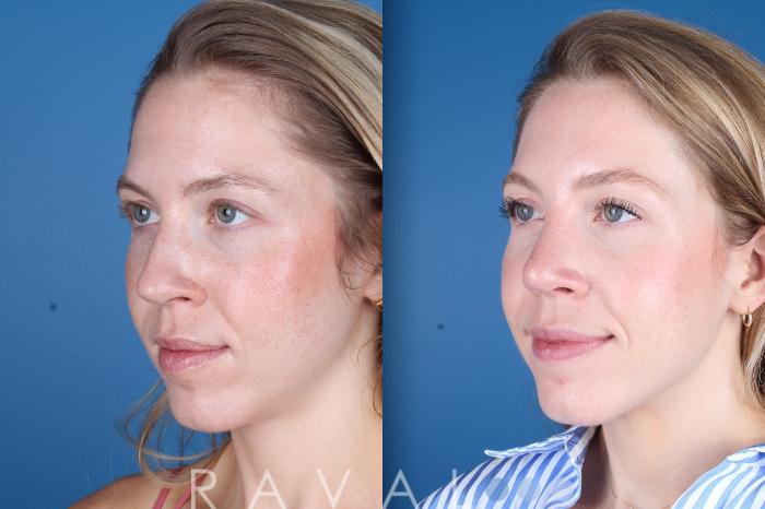 Before & After Rhinoplasty Case 1037 View 3 View in Denver, CO