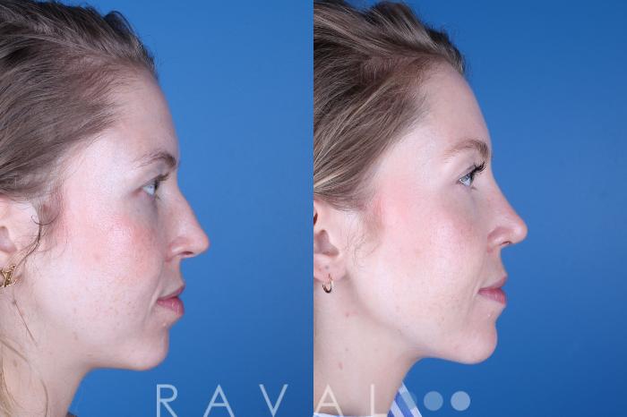Before & After Rhinoplasty Case 1037 View 4 View in Denver, CO