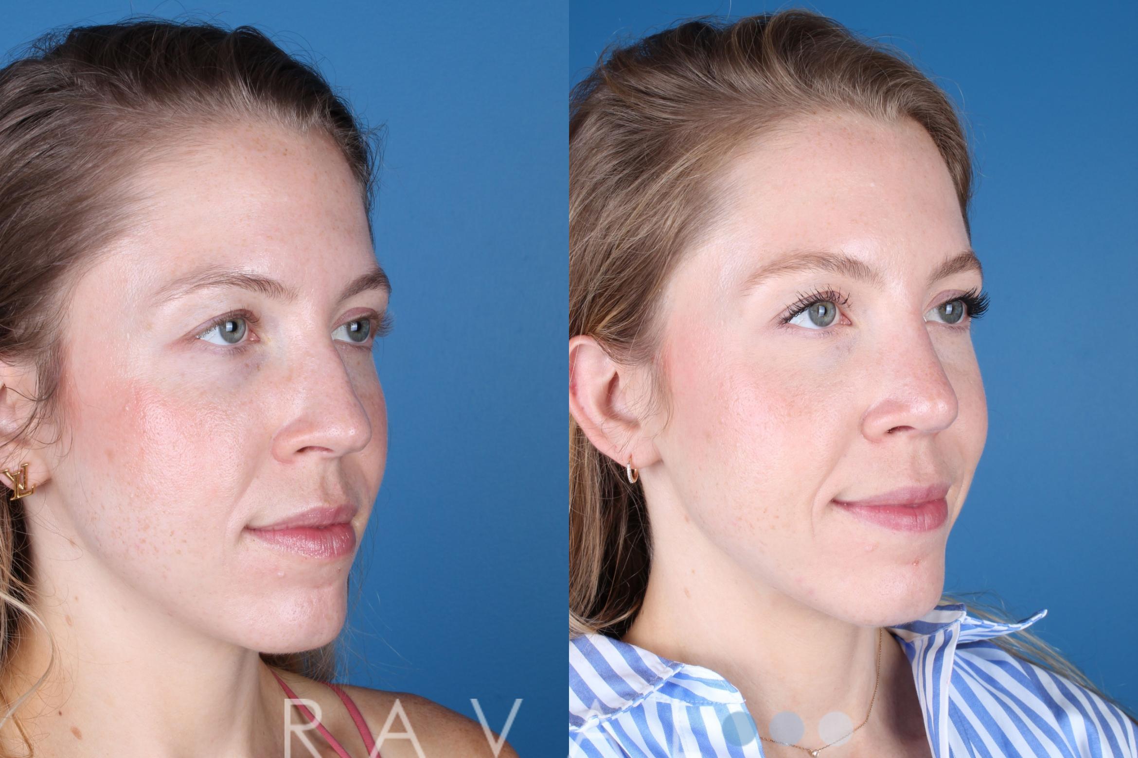Before & After Rhinoplasty Case 1037 View 5 View in Denver, CO