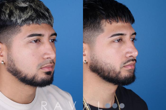 Before & After Rhinoplasty Case 1038 View 1 View in Denver, CO