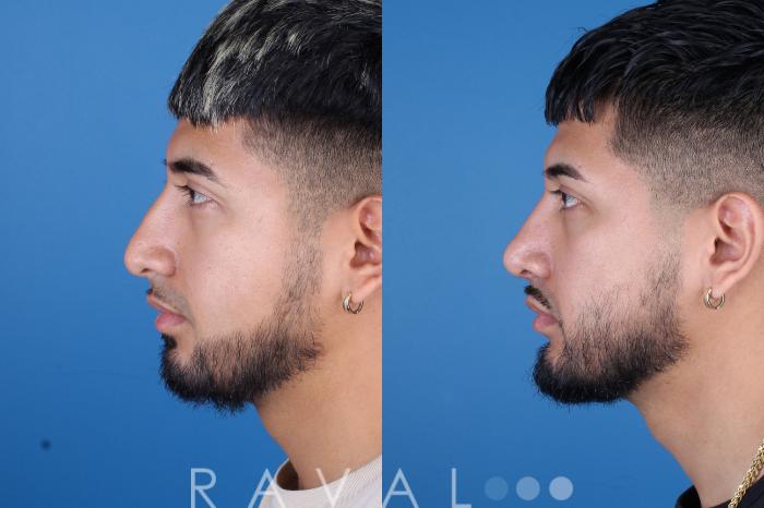 Before & After Rhinoplasty Case 1038 View 2 View in Denver, CO