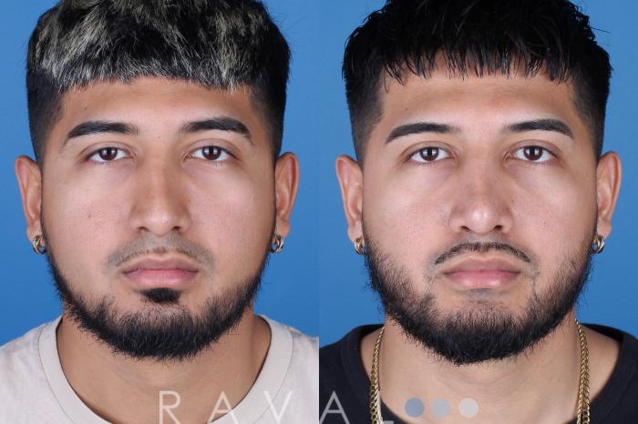 Before & After Rhinoplasty Case 1038 View 3 View in Denver, CO