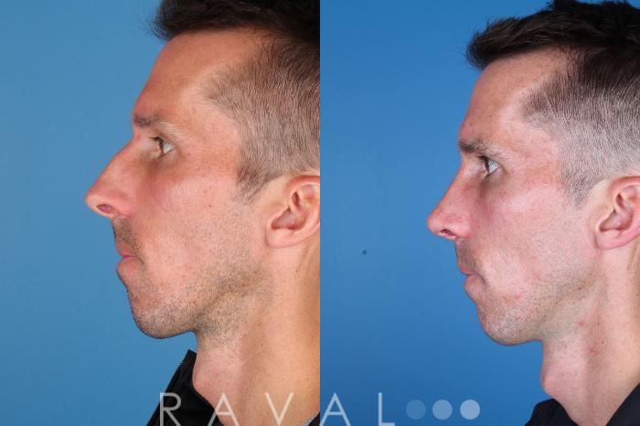 Before & After Rhinoplasty Case 1039 View 2 View in Denver, CO