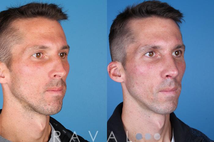 Before & After Rhinoplasty Case 1039 View 3 View in Denver, CO
