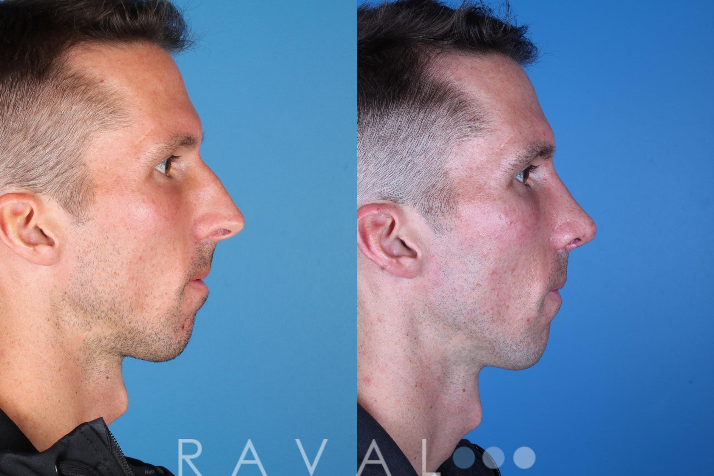 Before & After Rhinoplasty Case 1039 View 4 View in Denver, CO