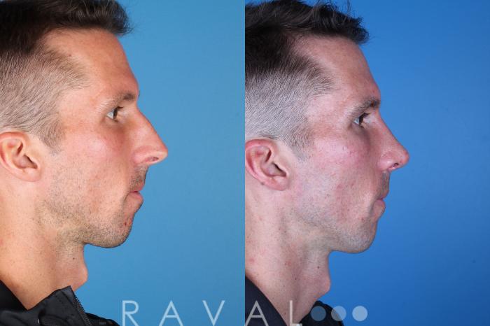 Before & After Rhinoplasty Case 1039 View 4 View in Denver, CO