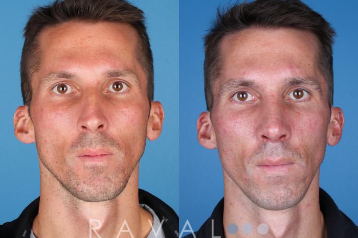 Before & After Rhinoplasty Case 1039 View 5 View in Denver, CO