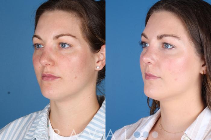 Before & After Rhinoplasty Case 1040 View 1 View in Denver, CO