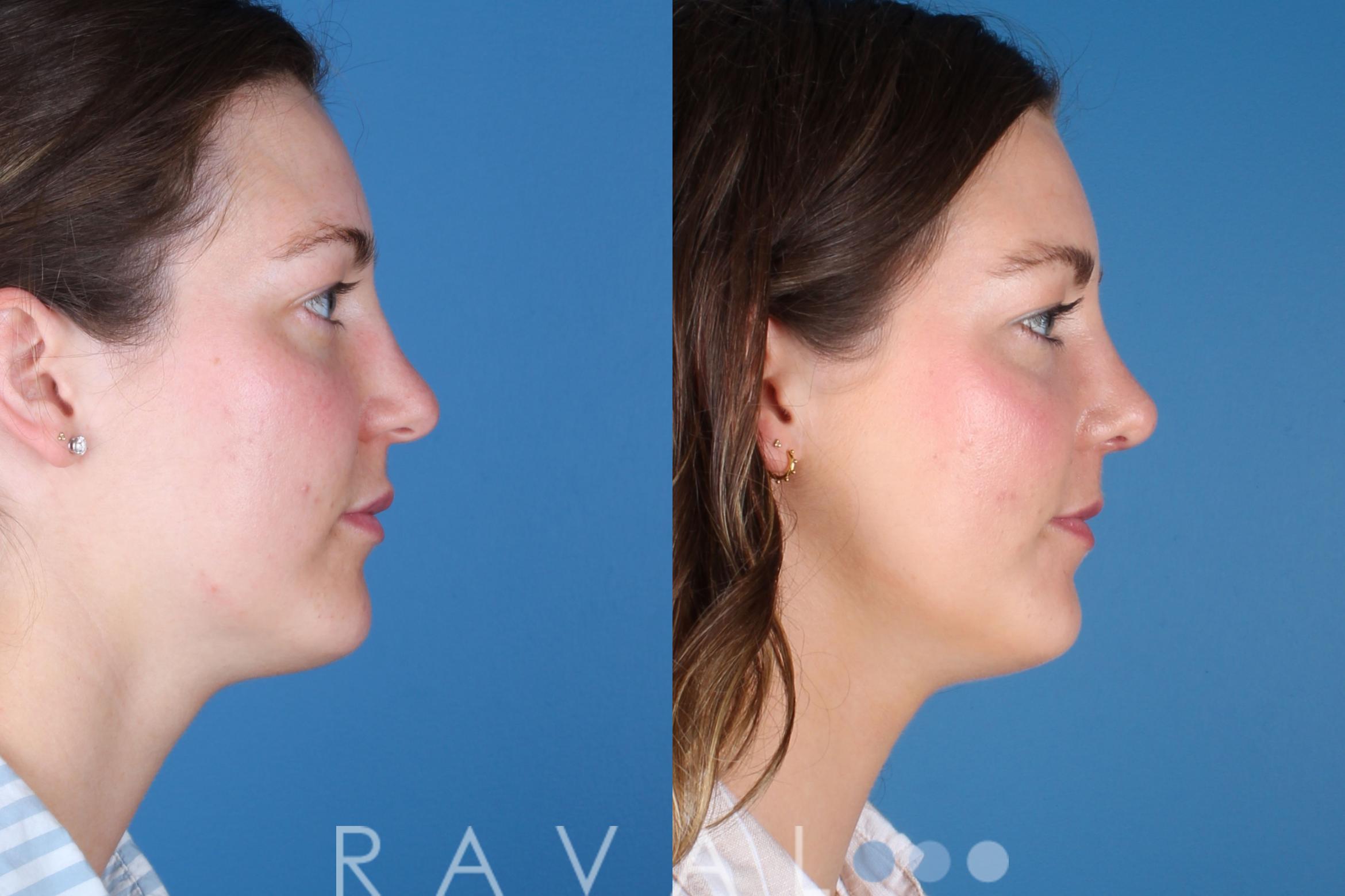 Before & After Rhinoplasty Case 1040 View 2 View in Denver, CO
