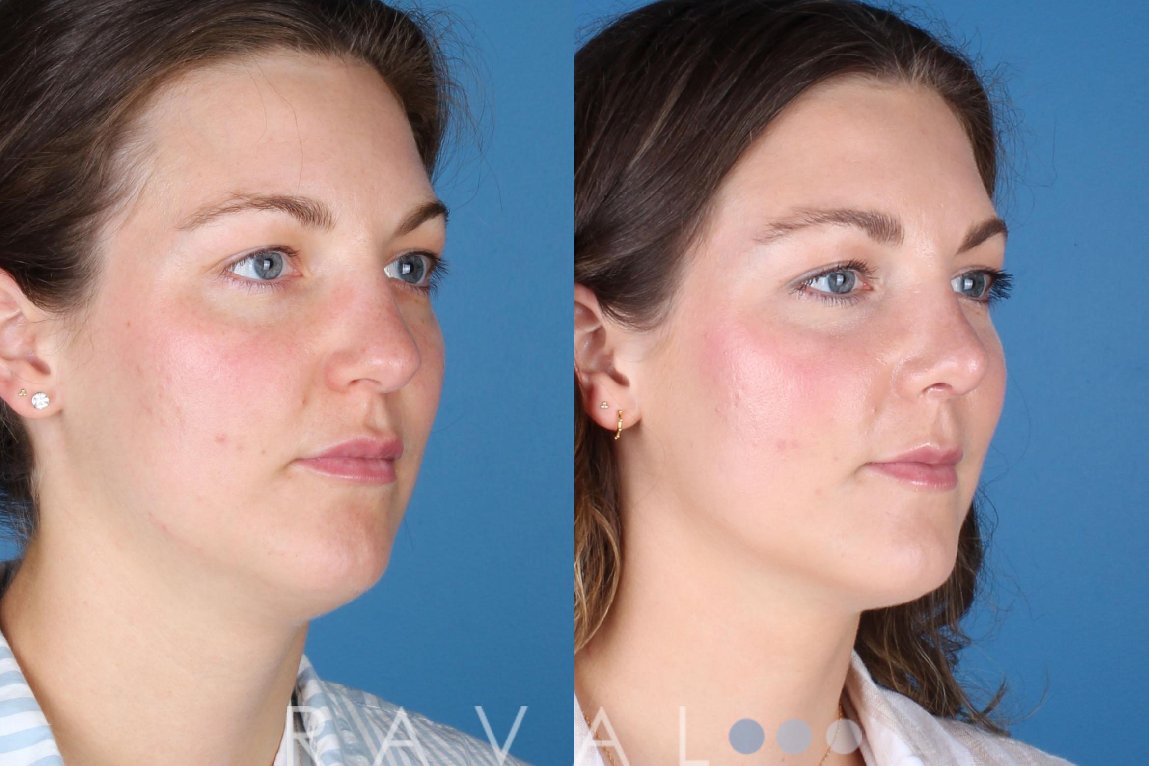 Before & After Rhinoplasty Case 1040 View 3 View in Denver, CO