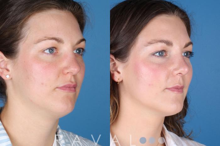 Before & After Rhinoplasty Case 1040 View 3 View in Denver, CO
