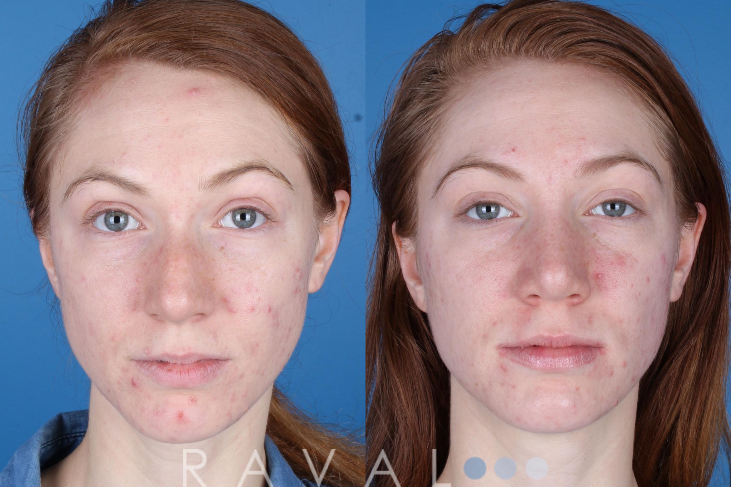 Before & After Rhinoplasty Case 1041 View 2 View in Denver, CO