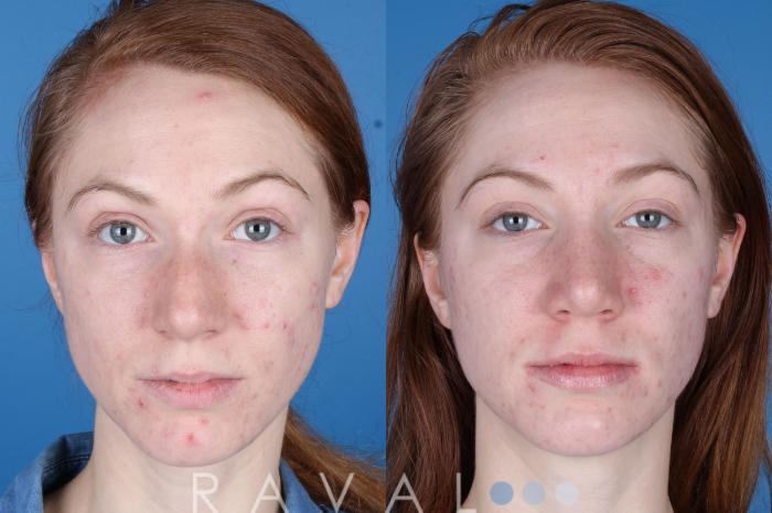 Before & After Rhinoplasty Case 1041 View 2 View in Denver, CO