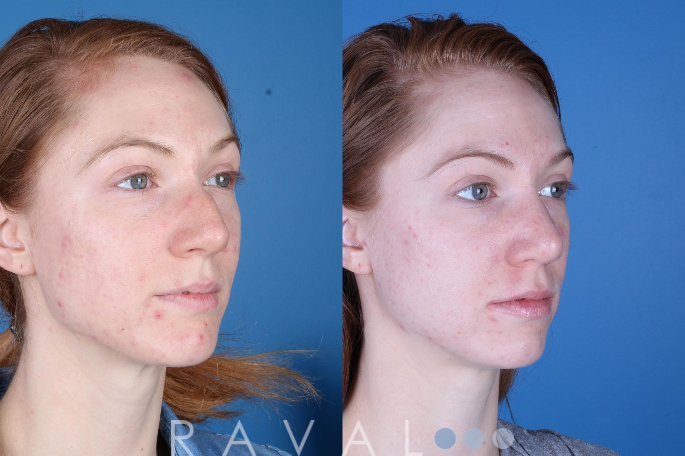 Before & After Rhinoplasty Case 1041 View 3 View in Denver, CO