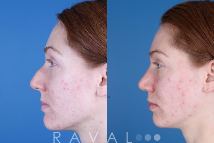 Before & After Rhinoplasty Case 1041 View 4 View in Denver, CO