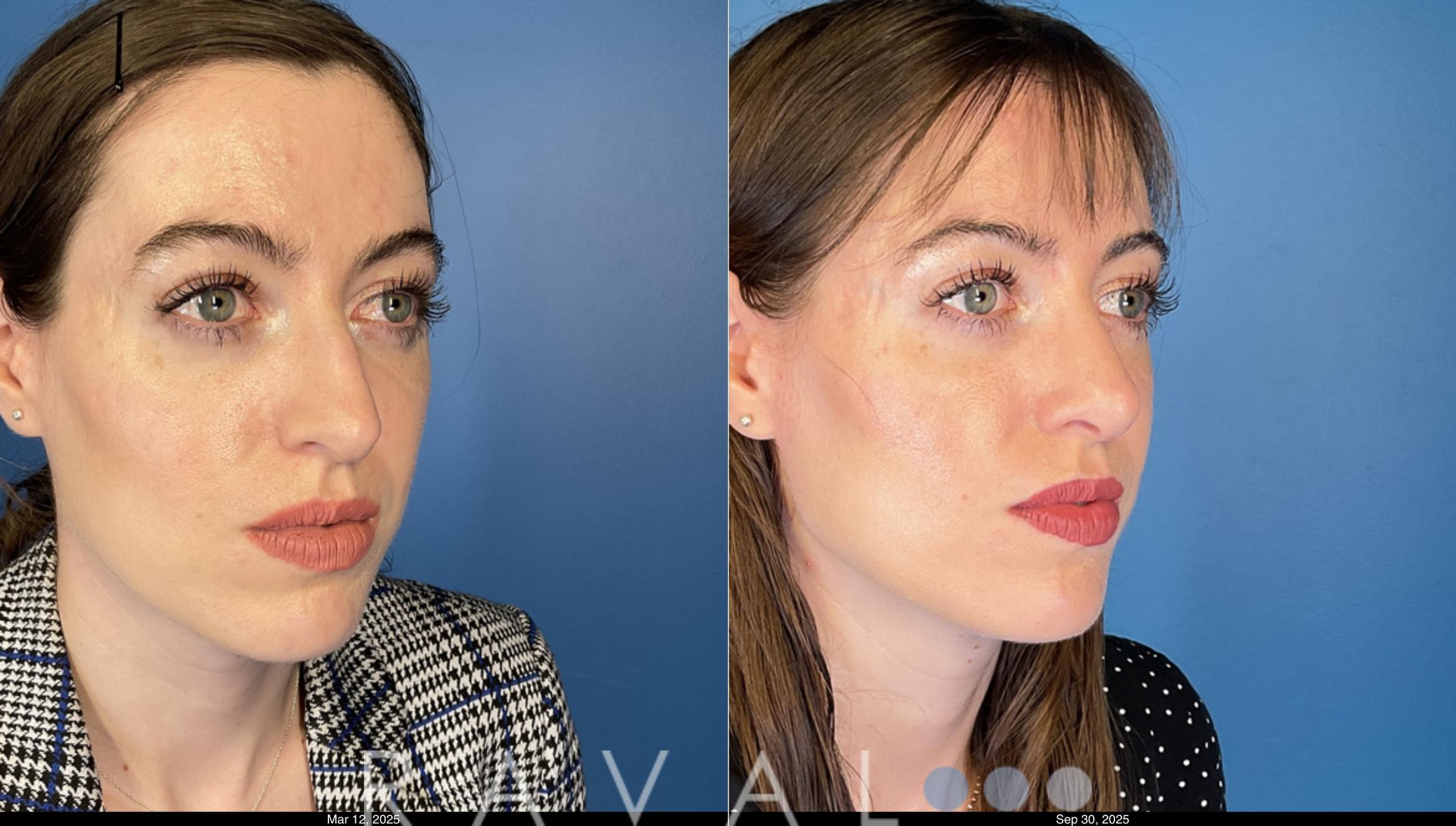 Before & After Rhinoplasty Case 1042 View 1 View in Denver, CO
