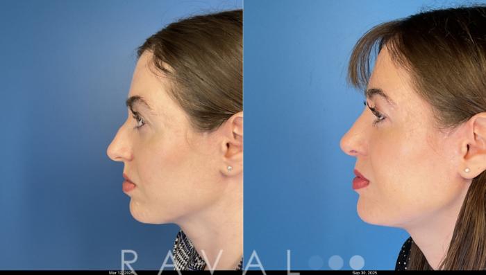 Before & After Rhinoplasty Case 1042 View 2 View in Denver, CO