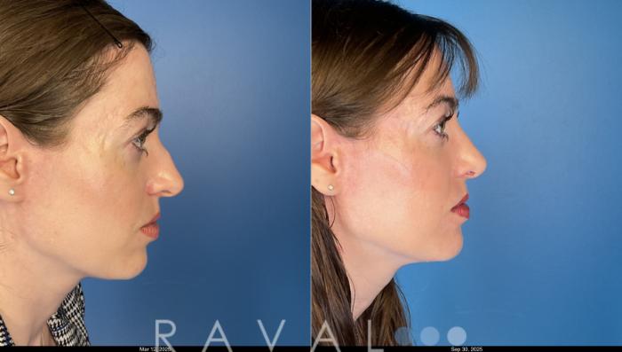 Before & After Rhinoplasty Case 1042 View 3 View in Denver, CO