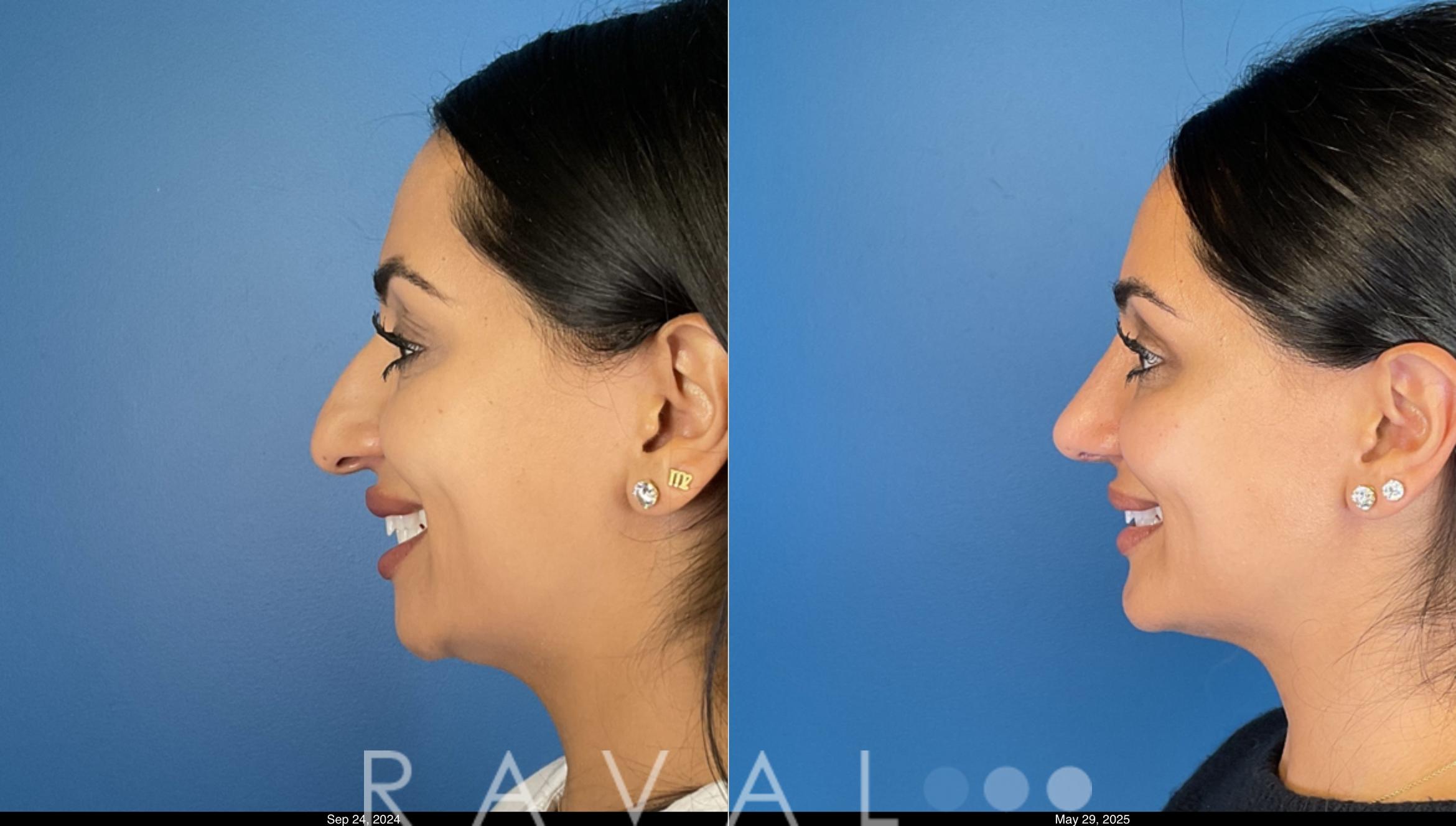Before & After Rhinoplasty Case 1043 View 1 View in Denver, CO