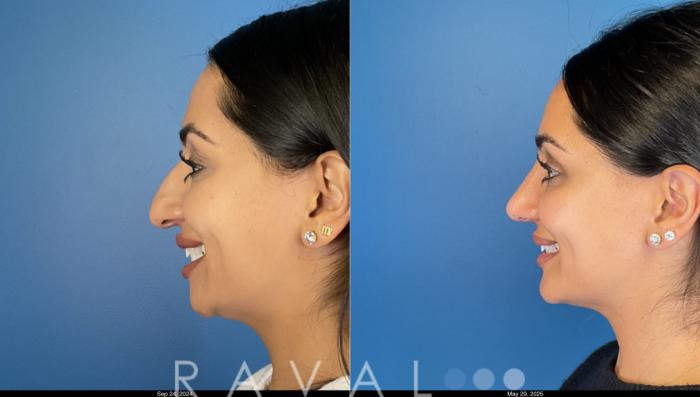 Before & After Rhinoplasty Case 1043 View 1 View in Denver, CO
