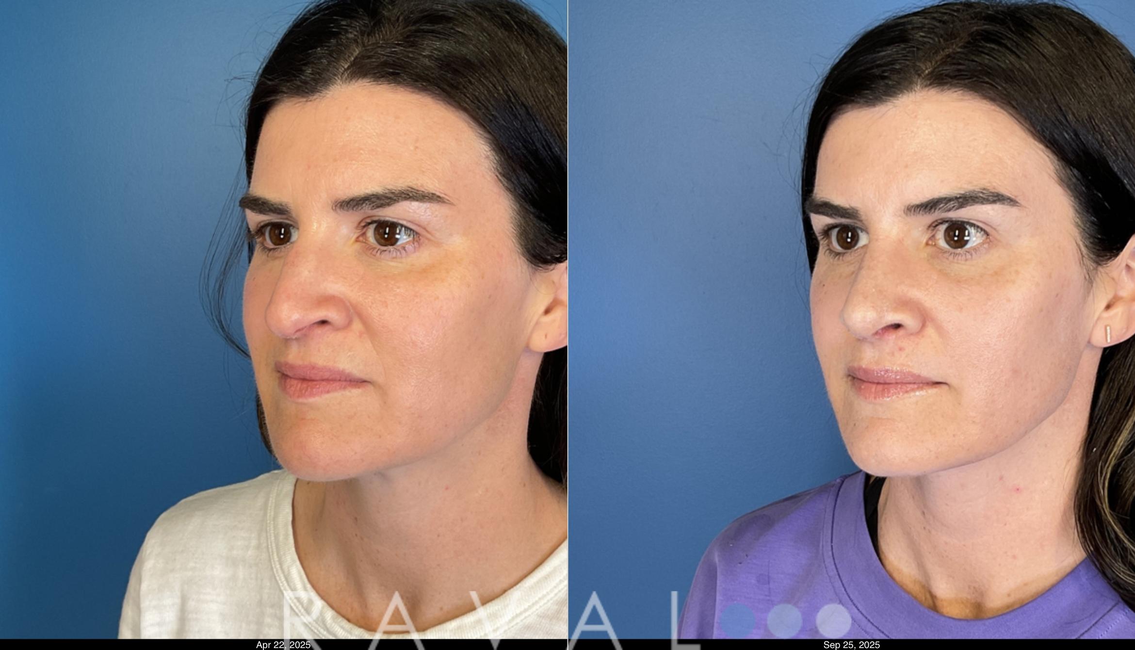 Before & After Rhinoplasty Case 1044 View 2 View in Denver, CO