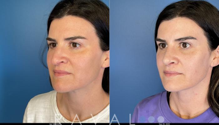 Before & After Rhinoplasty Case 1044 View 2 View in Denver, CO