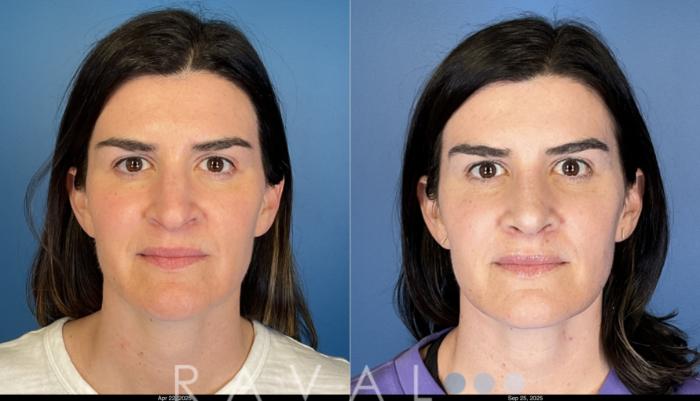 Before & After Rhinoplasty Case 1044 View 3 View in Denver, CO
