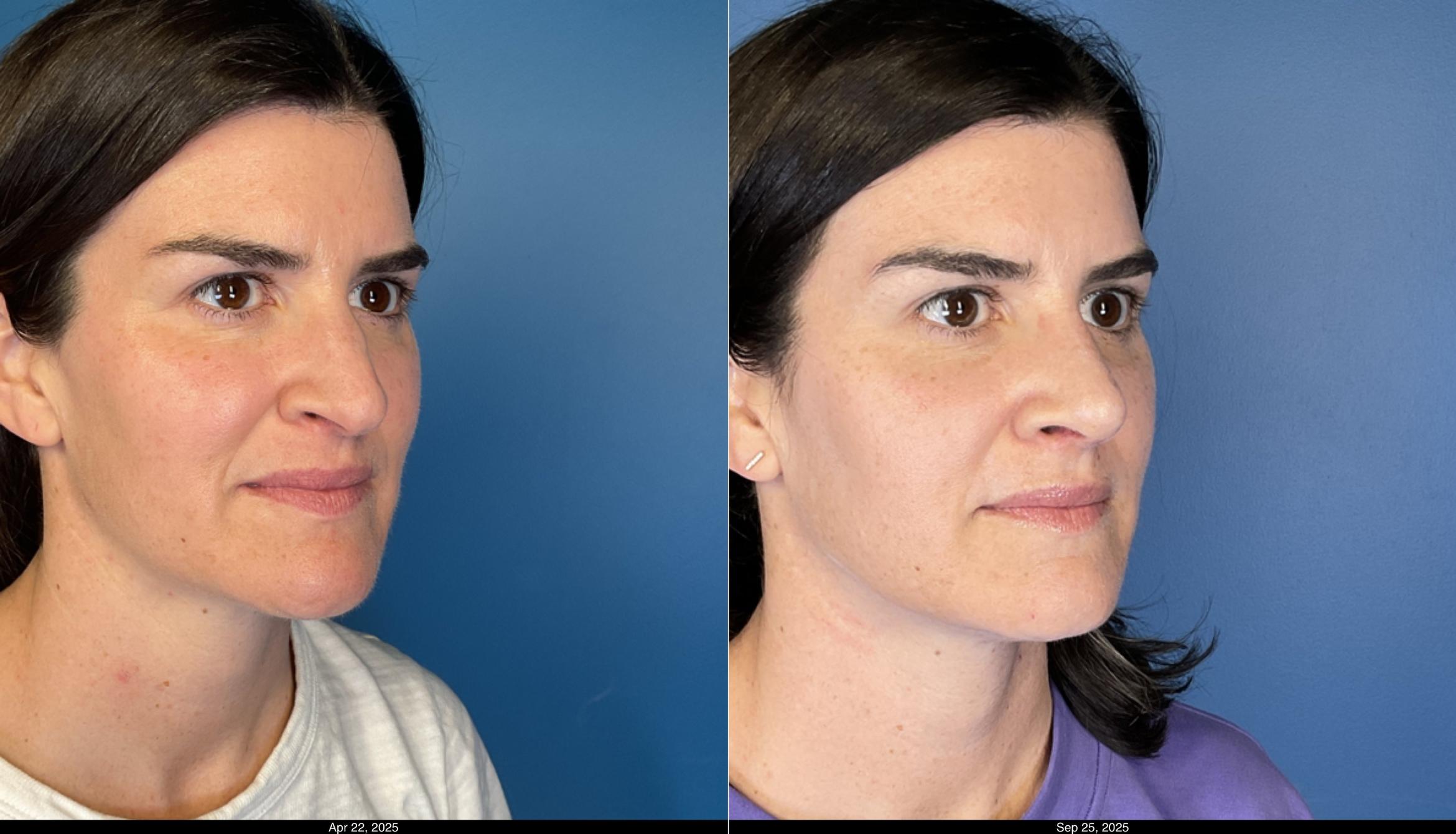 Before & After Rhinoplasty Case 1044 View 4 View in Denver, CO