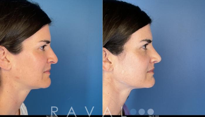 Before & After Rhinoplasty Case 1044 View 5 View in Denver, CO