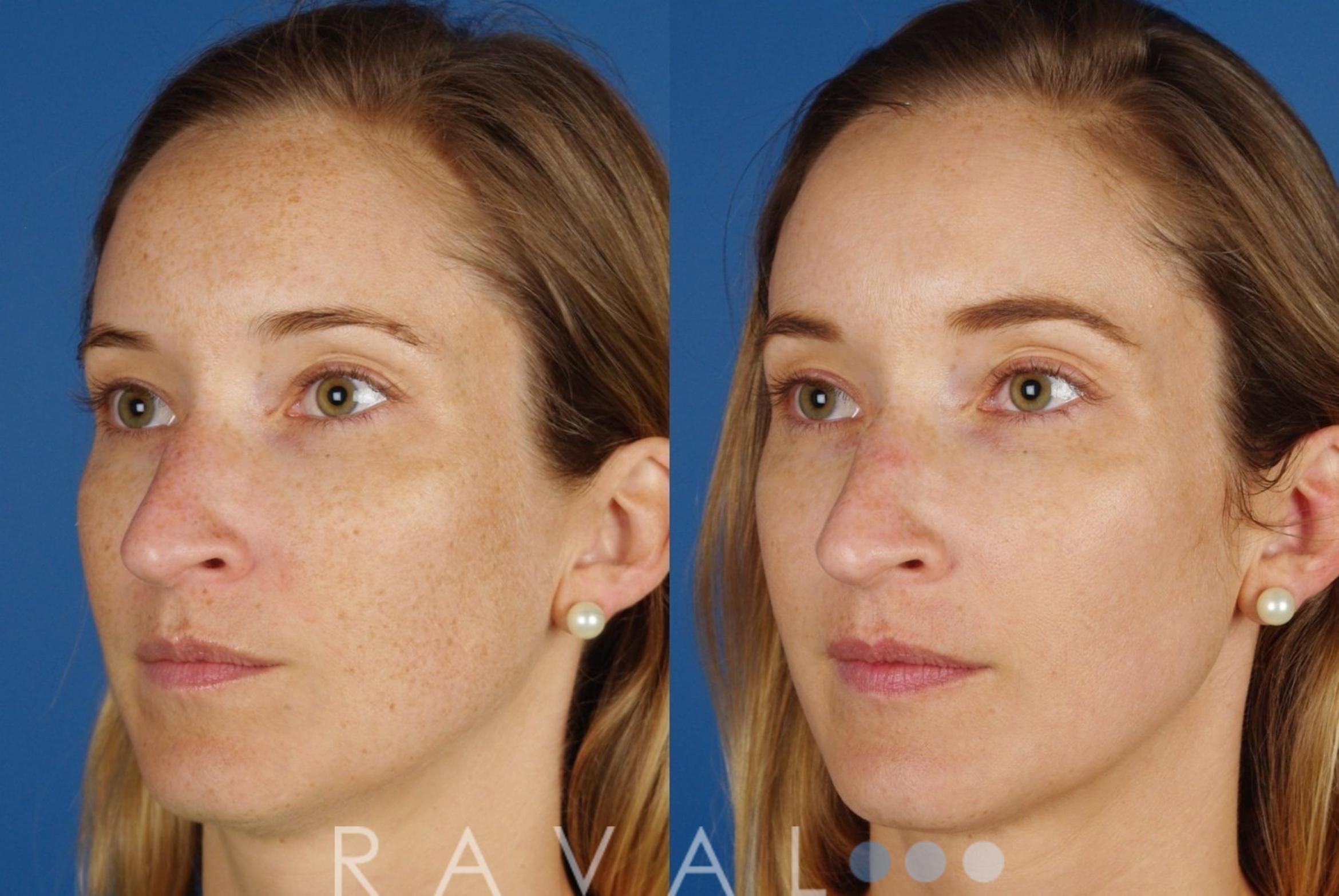 Before & After Skin Treatments Case 1085 View 2 View in Denver, CO