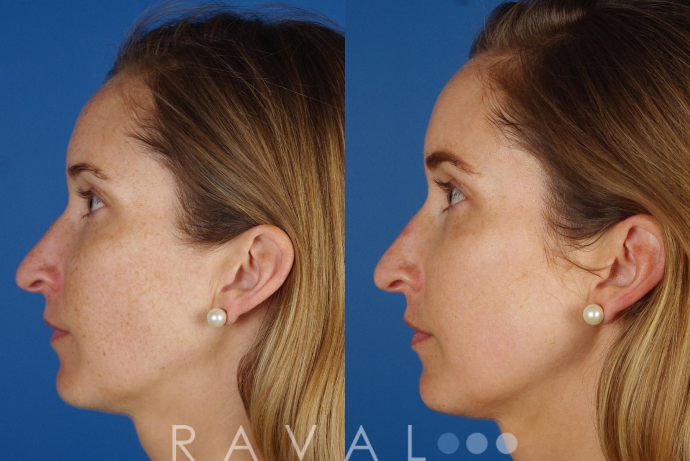 Before & After Skin Treatments Case 1085 View 3 View in Denver, CO