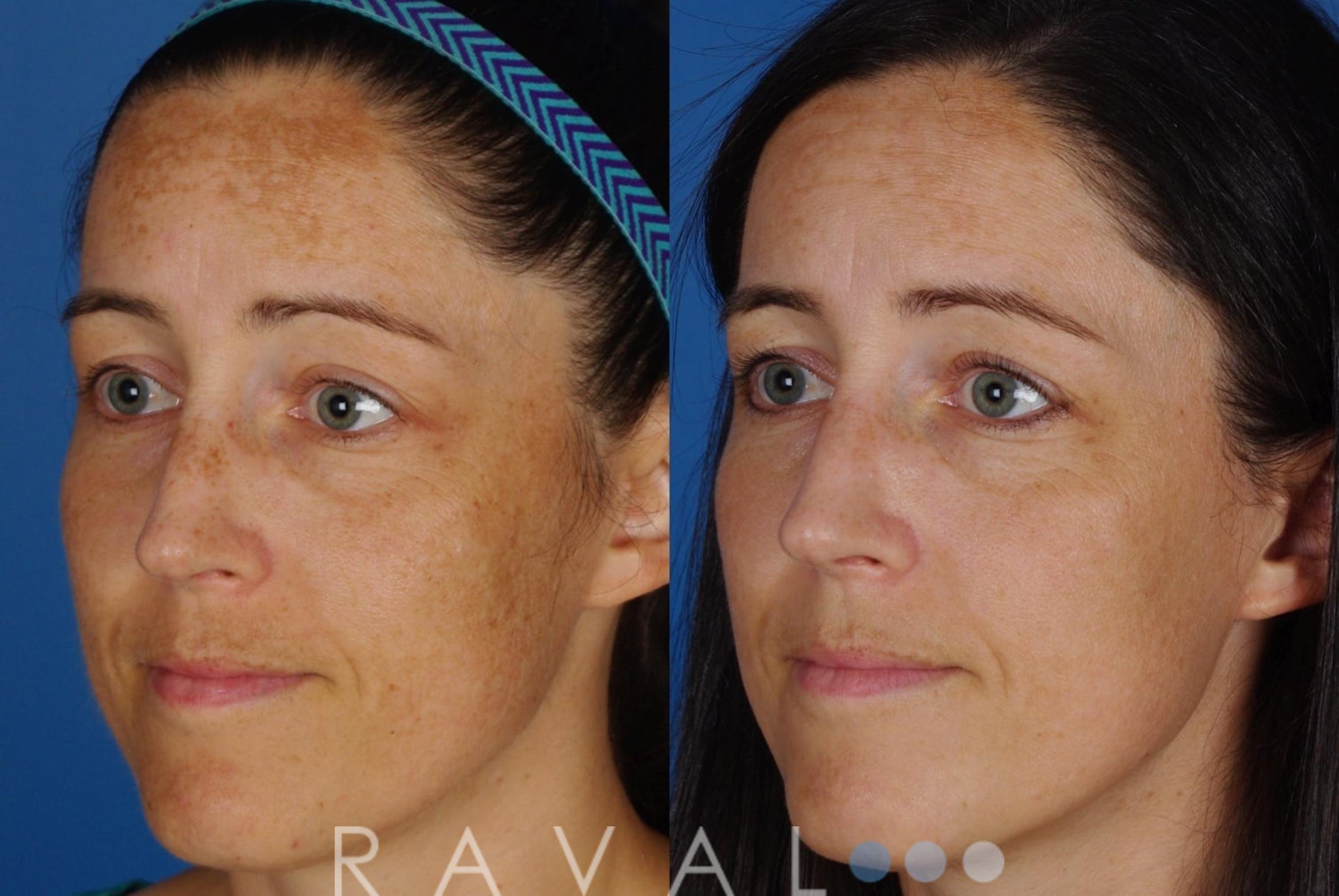 Before & After Skin Treatments Case 1086 View 1 View in Denver, CO