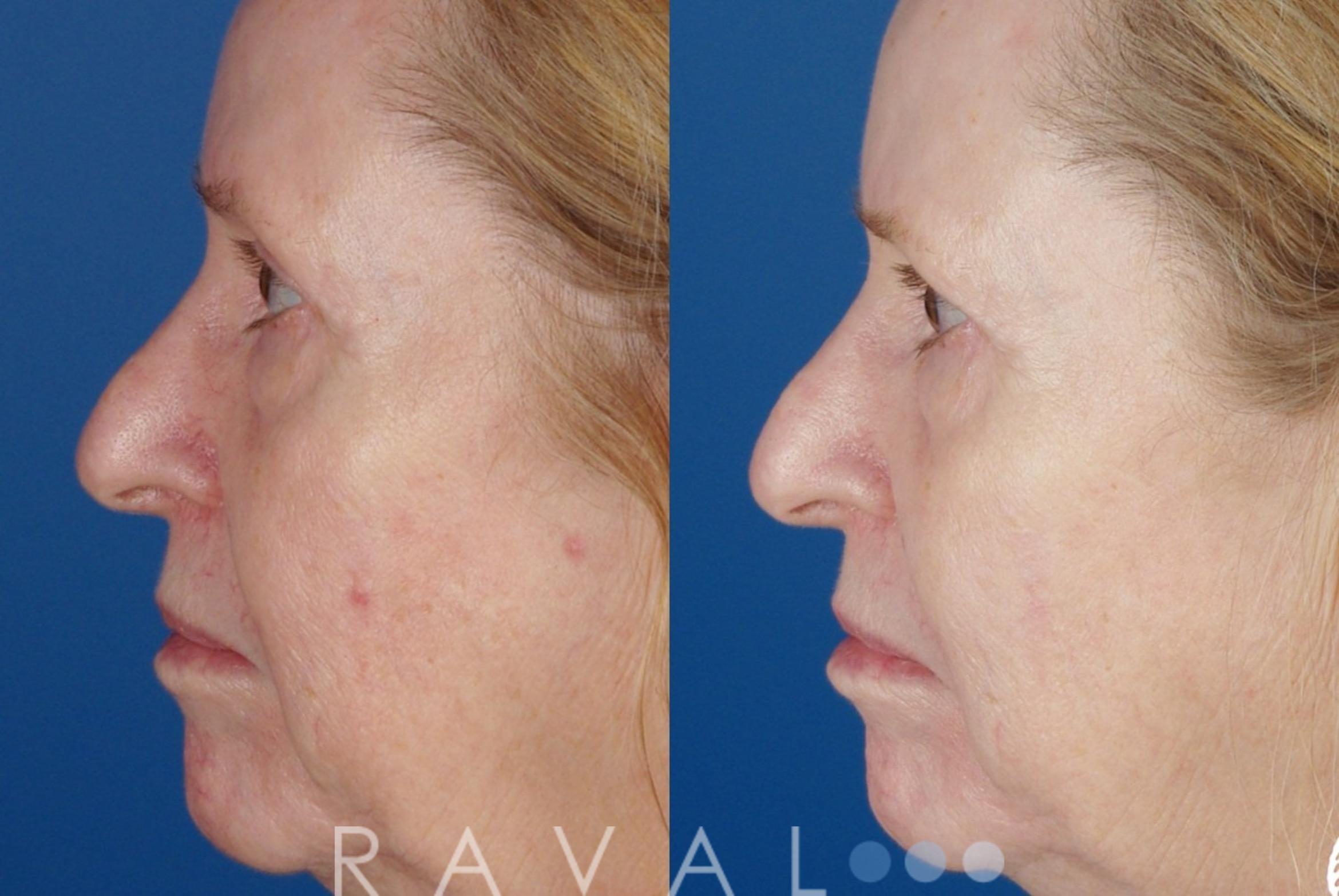 Before & After Skin Treatments Case 1087 View 1 View in Denver, CO