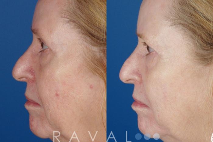 Before & After Skin Treatments Case 1087 View 1 View in Denver, CO