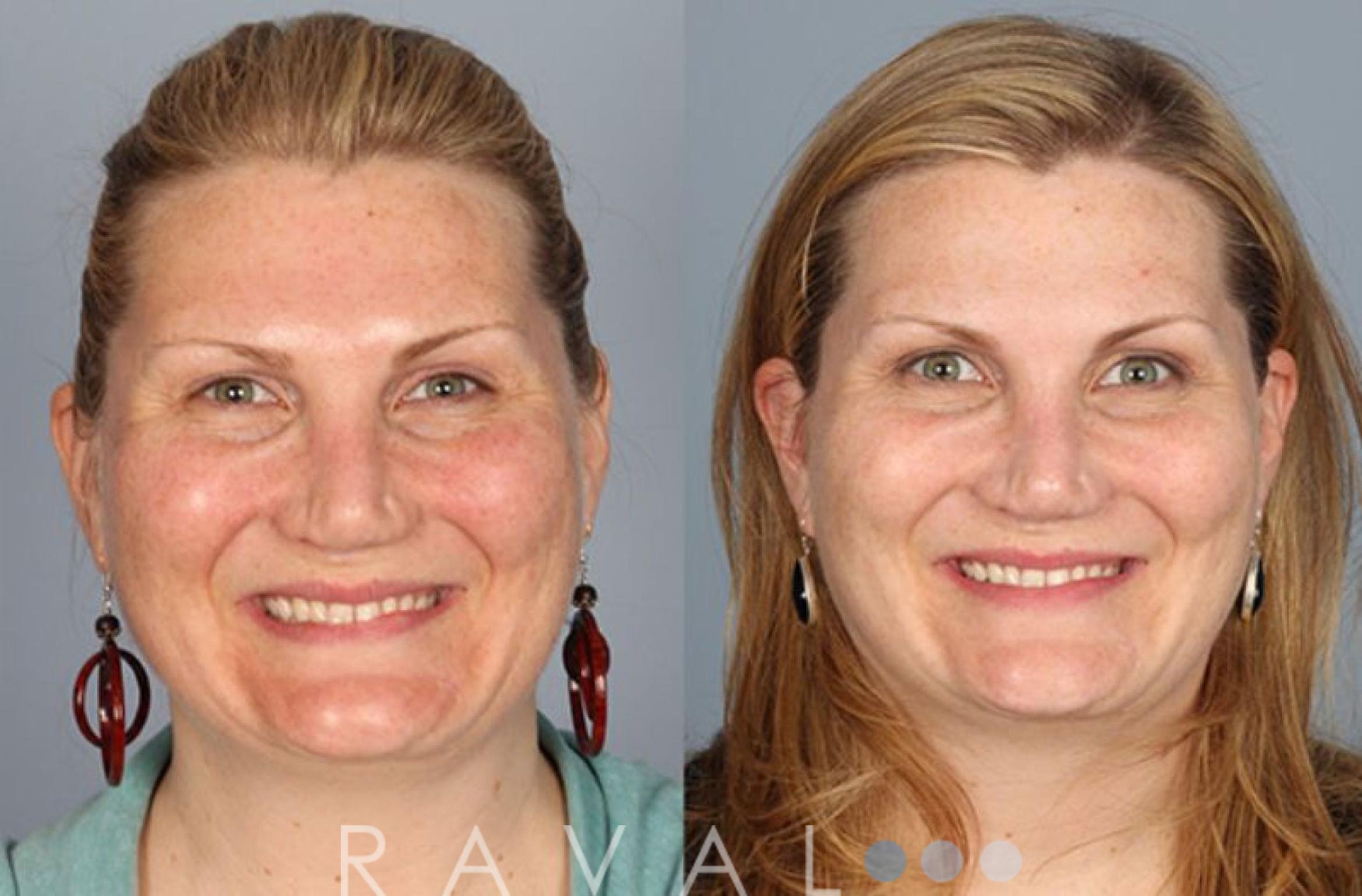 Before & After Skin Treatments Case 1088 View 1 View in Denver, CO