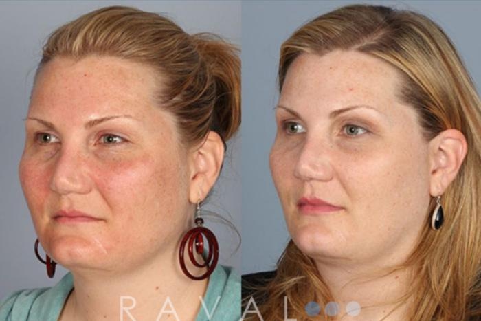 Before & After Skin Treatments Case 1088 View 2 View in Denver, CO