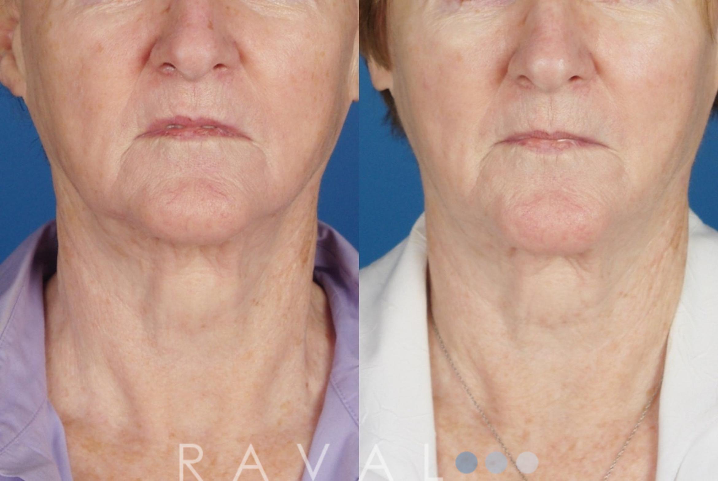 Before & After Skin Treatments Case 1089 View 1 View in Denver, CO