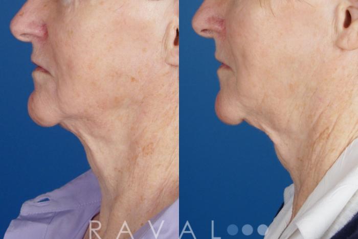 Before & After Skin Treatments Case 1089 View 2 View in Denver, CO