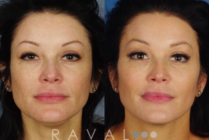 Before & After Skin Treatments Case 1090 View 1 View in Denver, CO