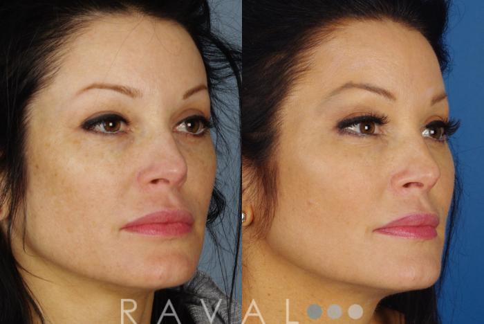 Before & After Skin Treatments Case 1090 View 2 View in Denver, CO